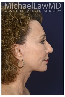 Facelift After Photo by Michael Law, MD; Raleigh, NC - Case 34226