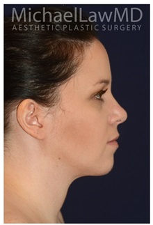 Facelift After Photo by Michael Law, MD; Raleigh, NC - Case 34227