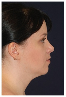 Facelift Before Photo by Michael Law, MD; Raleigh, NC - Case 34227