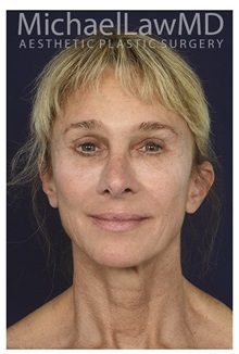Facelift After Photo by Michael Law, MD; Raleigh, NC - Case 34228