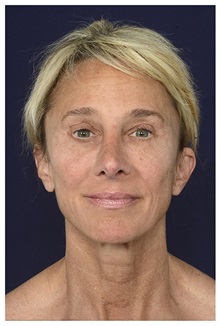 Facelift Before Photo by Michael Law, MD; Raleigh, NC - Case 34228