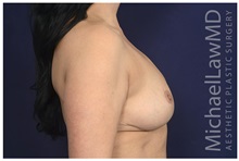 Breast Reduction After Photo by Michael Law, MD; Raleigh, NC - Case 34229