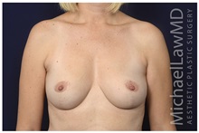 Breast Reduction After Photo by Michael Law, MD; Raleigh, NC - Case 34230
