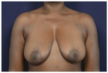 Breast Reduction Before Photo by Michael Law, MD; Raleigh, NC - Case 34231