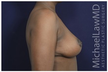 Breast Reduction After Photo by Michael Law, MD; Raleigh, NC - Case 34231