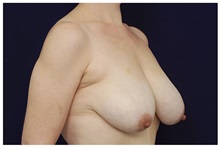 Breast Reduction Before Photo by Michael Law, MD; Raleigh, NC - Case 34236