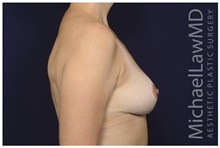 Breast Reduction After Photo by Michael Law, MD; Raleigh, NC - Case 34236