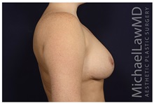 Breast Reduction After Photo by Michael Law, MD; Raleigh, NC - Case 34237