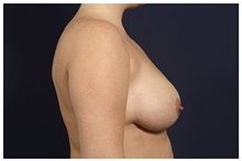 Breast Reduction Before Photo by Michael Law, MD; Raleigh, NC - Case 34237
