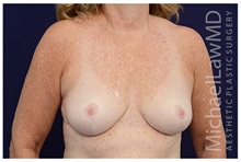 Breast Reduction After Photo by Michael Law, MD; Raleigh, NC - Case 34238