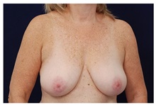 Breast Reduction Before Photo by Michael Law, MD; Raleigh, NC - Case 34238
