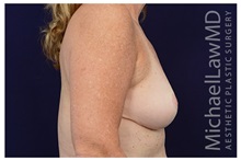 Breast Reduction After Photo by Michael Law, MD; Raleigh, NC - Case 34238