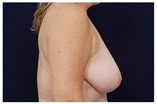 Breast Reduction Before Photo by Michael Law, MD; Raleigh, NC - Case 34238