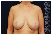 Breast Reduction After Photo by Michael Law, MD; Raleigh, NC - Case 34239