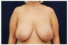 Breast Reduction Before Photo by Michael Law, MD; Raleigh, NC - Case 34239