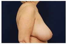 Breast Reduction Before Photo by Michael Law, MD; Raleigh, NC - Case 34239