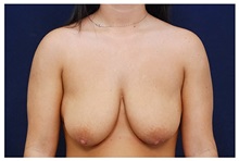 Breast Reduction Before Photo by Michael Law, MD; Raleigh, NC - Case 34240