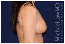 Breast Reduction After Photo by Michael Law, MD; Raleigh, NC - Case 34240