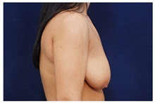 Breast Reduction Before Photo by Michael Law, MD; Raleigh, NC - Case 34240