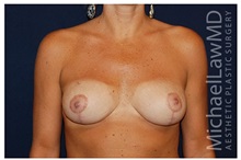 Breast Reduction After Photo by Michael Law, MD; Raleigh, NC - Case 34241