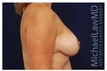 Breast Reduction After Photo by Michael Law, MD; Raleigh, NC - Case 34242