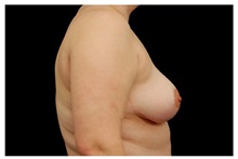 Breast Reduction After Photo by Michael Law, MD; Raleigh, NC - Case 34244