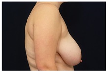 Breast Reduction Before Photo by Michael Law, MD; Raleigh, NC - Case 34244