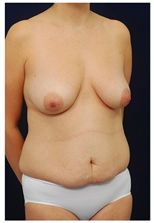Body Contouring Before Photo by Michael Law, MD; Raleigh, NC - Case 34246