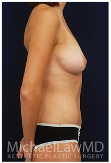 Body Contouring After Photo by Michael Law, MD; Raleigh, NC - Case 34246