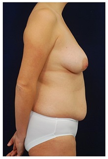 Body Contouring Before Photo by Michael Law, MD; Raleigh, NC - Case 34246
