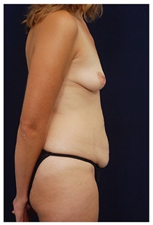 Body Contouring Before Photo by Michael Law, MD; Raleigh, NC - Case 34251