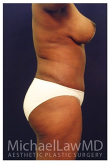 Body Contouring After Photo by Michael Law, MD; Raleigh, NC - Case 34252