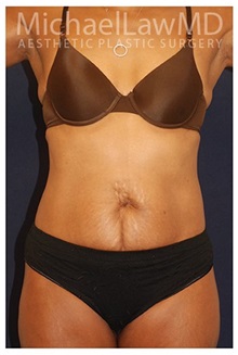 Body Contouring After Photo by Michael Law, MD; Raleigh, NC - Case 34253