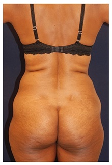 Body Contouring Before Photo by Michael Law, MD; Raleigh, NC - Case 34253