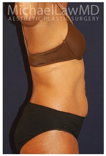 Body Contouring After Photo by Michael Law, MD; Raleigh, NC - Case 34253