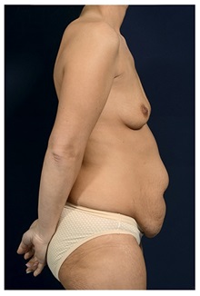 Body Contouring Before Photo by Michael Law, MD; Raleigh, NC - Case 34258