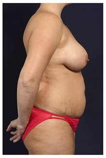 Body Contouring Before Photo by Michael Law, MD; Raleigh, NC - Case 34259