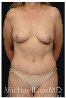 Body Contouring After Photo by Michael Law, MD; Raleigh, NC - Case 34261