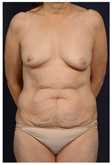 Body Contouring Before Photo by Michael Law, MD; Raleigh, NC - Case 34261