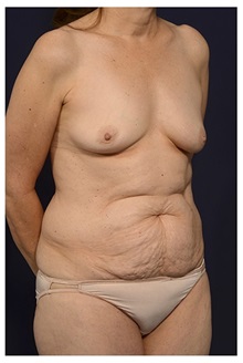 Body Contouring Before Photo by Michael Law, MD; Raleigh, NC - Case 34261