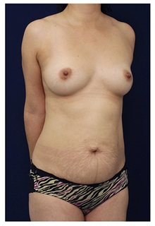 Body Contouring Before Photo by Michael Law, MD; Raleigh, NC - Case 34262