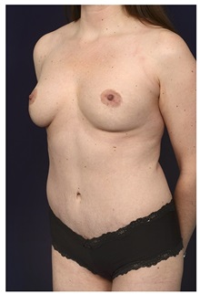 Body Contouring After Photo by Michael Law, MD; Raleigh, NC - Case 34263