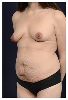 Body Contouring Before Photo by Michael Law, MD; Raleigh, NC - Case 34263