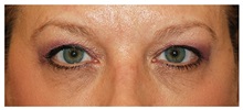 Eyelid Surgery Before Photo by Michael Law, MD; Raleigh, NC - Case 34280