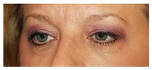 Eyelid Surgery Before Photo by Michael Law, MD; Raleigh, NC - Case 34280