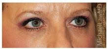 Eyelid Surgery After Photo by Michael Law, MD; Raleigh, NC - Case 34280