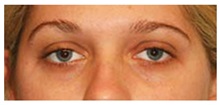 Brow Lift Before Photo by Michael Law, MD; Raleigh, NC - Case 34282