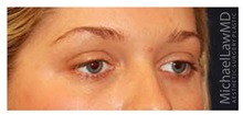 Brow Lift After Photo by Michael Law, MD; Raleigh, NC - Case 34282