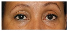Eyelid Surgery Before Photo by Michael Law, MD; Raleigh, NC - Case 34283