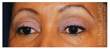 Eyelid Surgery After Photo by Michael Law, MD; Raleigh, NC - Case 34283